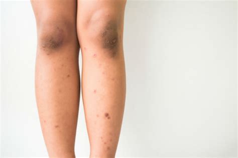 dark brown spots on legs